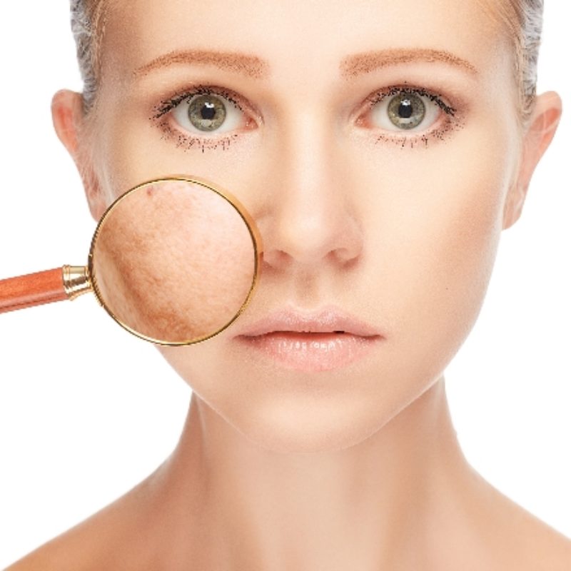 Przebarwienia na skórze – jak usunąć?